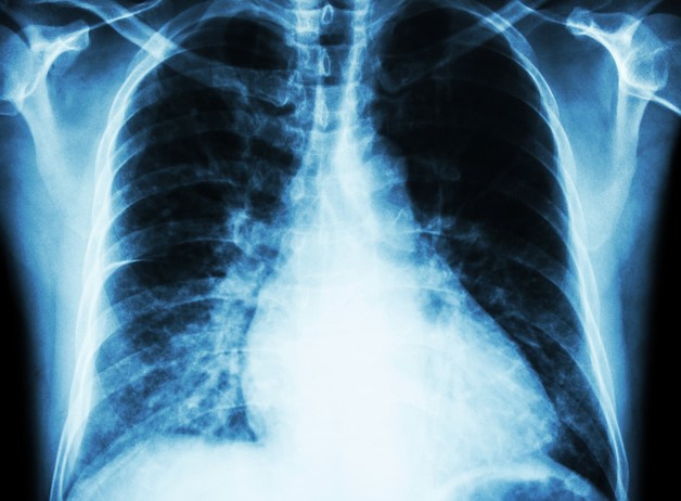 Radiographie du thorax, cœur - agrandissement