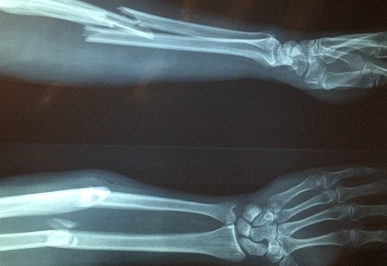 Radiographie de l'avant-bras avec signes de fracture de l'avant-bras, fracture compliquée avec luxation