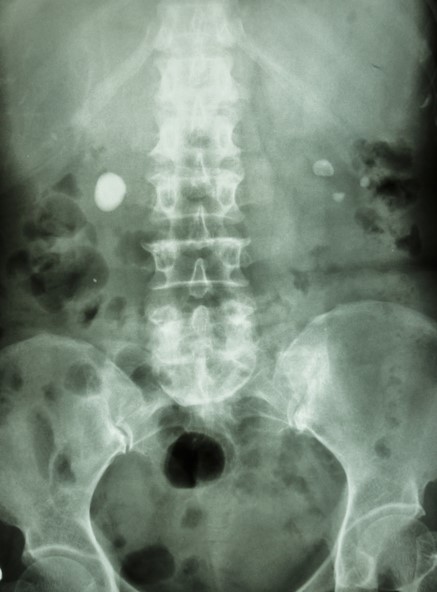 Radiographie de l'abdomen, calculs rénaux des deux côtés, dans les deux reins