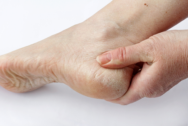 Peau sèche sur le pied, le talon ou entre les orteils en cas de dermatite fongique