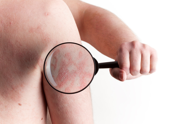 Psoriasis sur l'épaule - sous la loupe