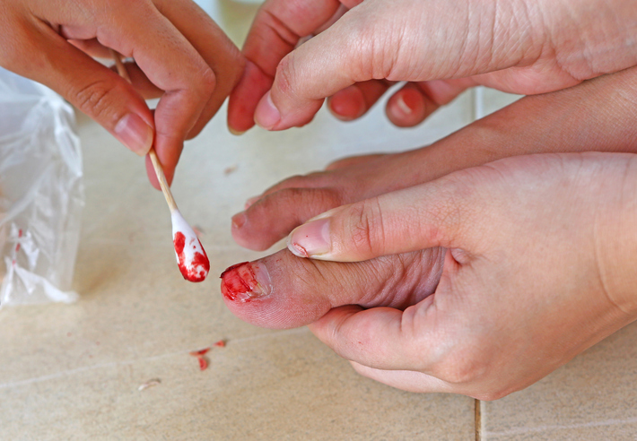 Lésion de l'ongle par blessure, saignement, traitement à l'aide d'un coton-tige