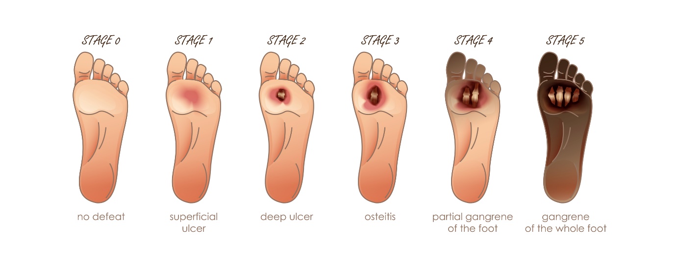 L'ulcère du pied et ses stades