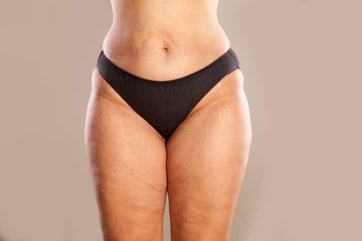 Cellulite, cuisses, femme