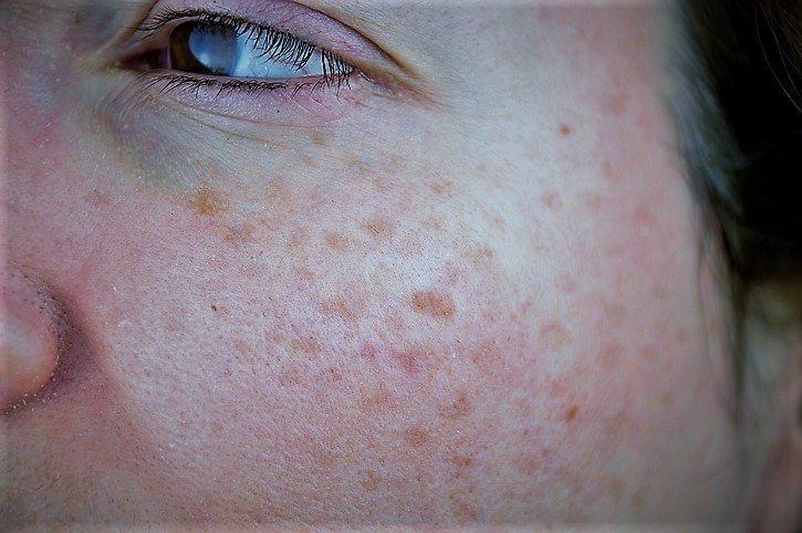 Femme, visage, hyperpigmentation