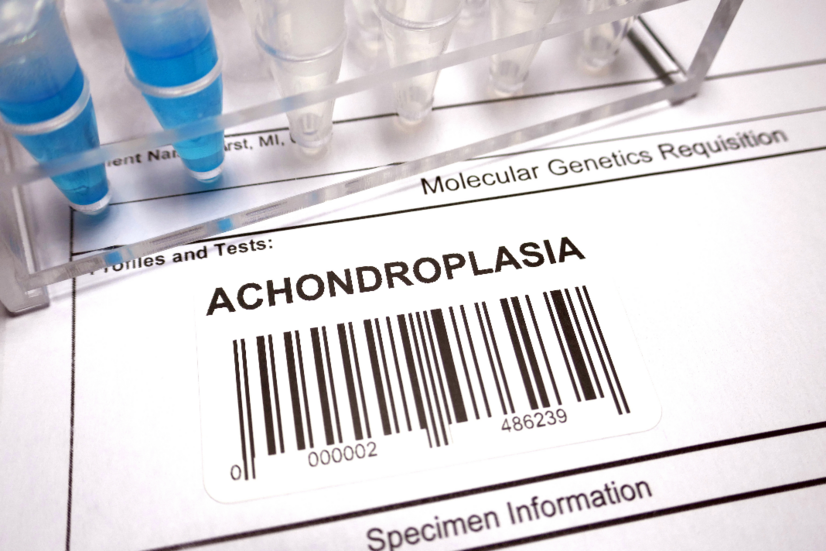 Achondroplasie : Quelles sont les causes et les symptômes de cette maladie osseuse congénitale ?