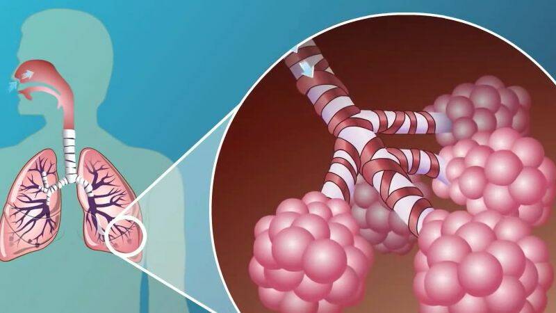 La bronchopneumopathie chronique obstructive : pourquoi et qui est à risque ?