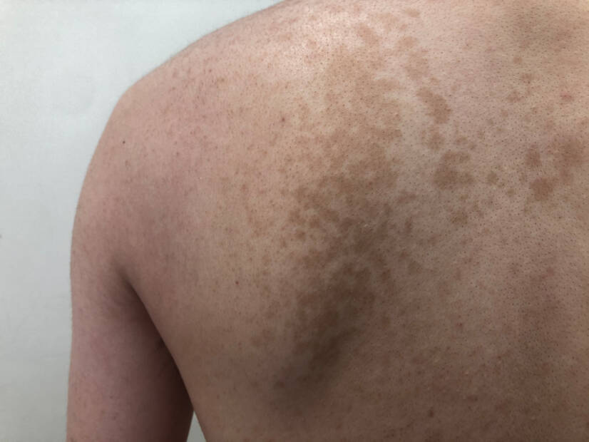 Pityriasis versicolor : Qu'est-ce que c'est, quels sont les symptômes, les causes et la transmission ?