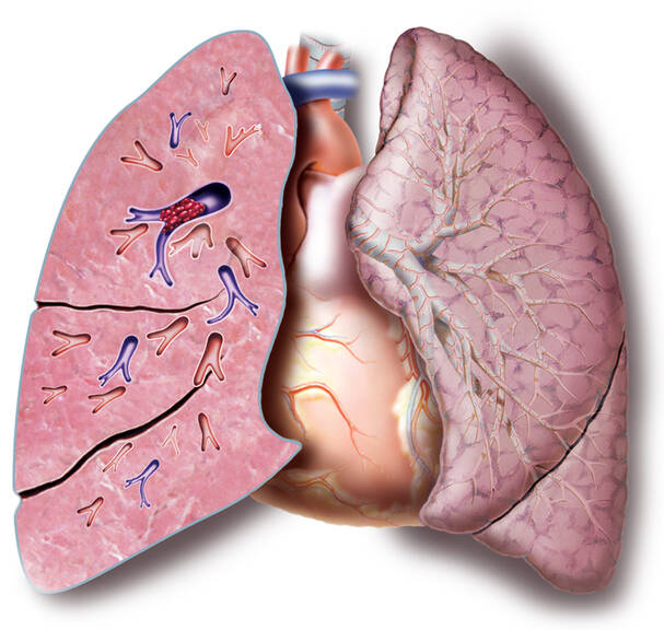 Embolie pulmonaire : pourquoi se produit-elle, comment se manifeste-t-elle, comment est-elle détectée et traitée ?