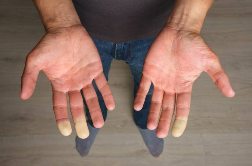 Syndrome de Raynaud : quelle est la cause de l'engourdissement des doigts ?