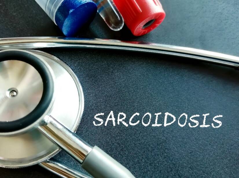 Sarcoïdose : Qu'est-ce que la sarcoïdose et quels sont ses causes/symptômes ? Formes pulmonaires et extrapulmonaires