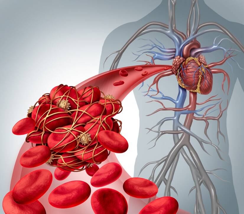 La maladie thromboembolique, pourquoi survient-elle, quel est son lien avec l'embolie pulmonaire ?