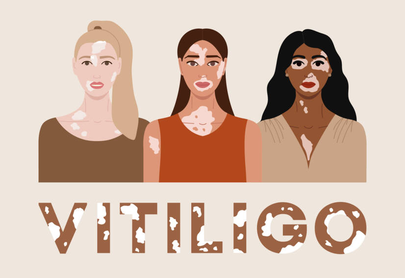 Vitiligo : Qu'est-ce que le vitiligo, quelles en sont les causes et les symptômes, et quand commence-t-il ?