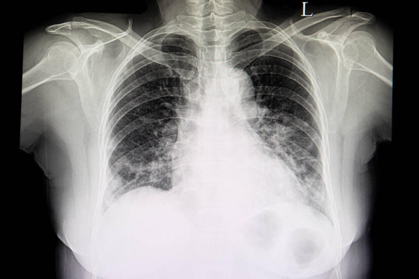 Comment se manifeste la pneumonie et quel est le traitement le plus efficace ?