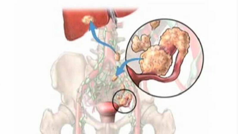 Kystes sur les ovaires : la rupture est-elle dangereuse et qu'en est-il de la grossesse ?