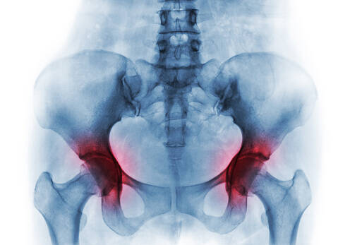 La coxarthrose de grade 4 se termine-t-elle par une arthroplastie de la hanche ?