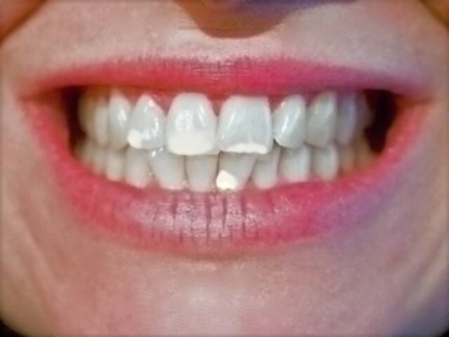 Les taches blanches sur les dents et leurs causes ? Comment se soigner et faire disparaître les taches ?