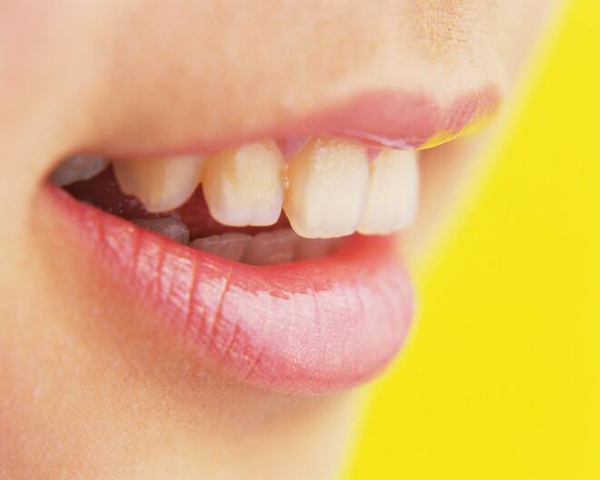 Dents branlantes : quelles sont les causes (chez l'adulte et l'enfant) ?