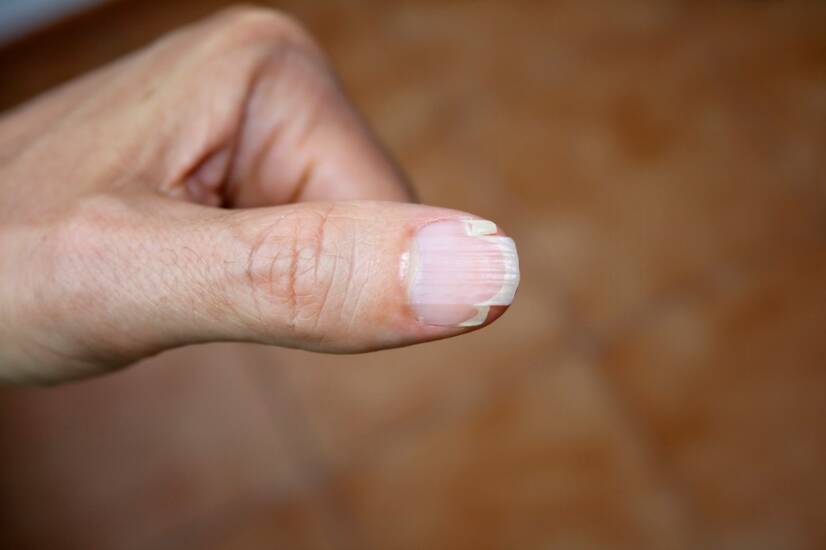 Les ongles cassants et leurs principales causes, comment les combattre ?