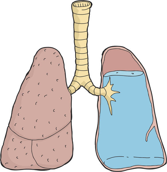 Œdème pulmonaire : Pourquoi l'œdème pulmonaire se produit-il ? Est-il une cause fréquente de décès ?