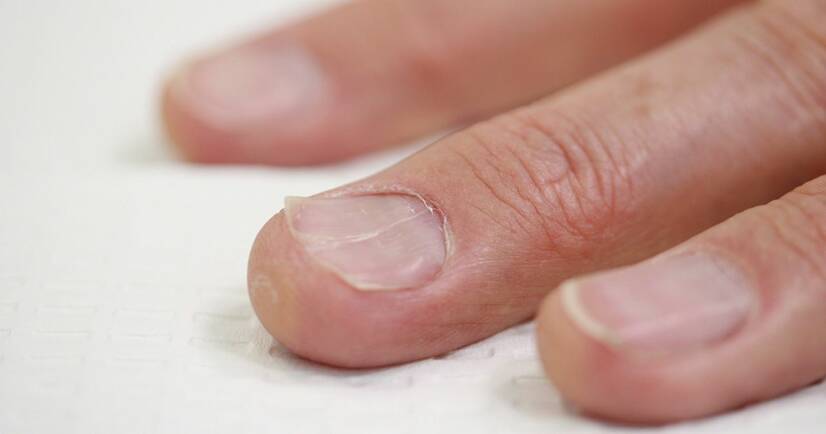 Ongles incarnés : causes, diagnostic et traitement