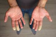 Syndrome de Raynaud : quelle est la cause de l'engourdissement des doigts ?