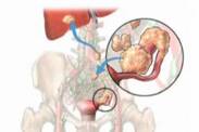 Kystes sur les ovaires : la rupture est-elle dangereuse et qu'en est-il de la grossesse ?