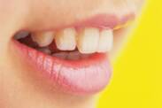 Dents branlantes : quelles sont les causes (chez l'adulte et l'enfant) ?