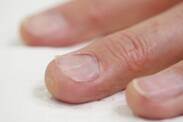 Ongles incarnés : causes, diagnostic et traitement